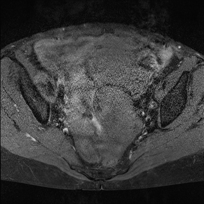 Cystadénocarcinome ovarien séro-papillaire moyennement différencié Stade IIIb Axial T1 Fat Sat