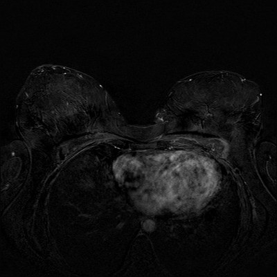 Récidive tardive de cancer du sein gauche Soustraction 2 min