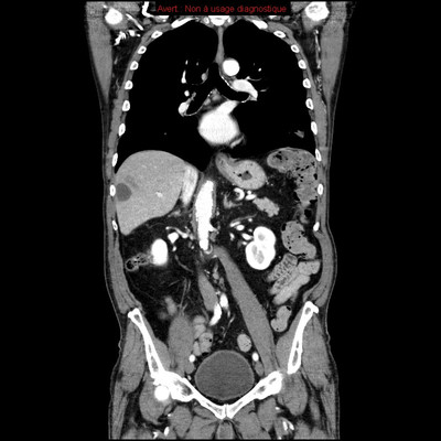 Hydatidose thoracique, hépatique et splénique avec nodules pulmonaires excavés  TDM Abdomen Coronal
