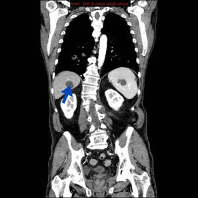 Hydatidose thoracique, hépatique et splénique avec nodules pulmonaires excavés  TDM Abdomen Coronal