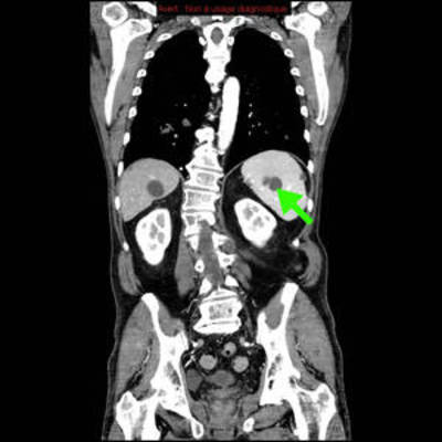 Hydatidose thoracique, hépatique et splénique avec nodules pulmonaires excavés  TDM Abdomen Coronal