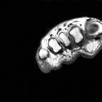 Syndrome du 2ème rayon et névrome de Morton du 2ème espace inter capito-métatarsien T1 Coronal Syndrome du 2ème rayon et névrome de Morton du 2ème espace inter capito-métatarsien T1 Coronal