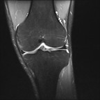 Synovite villo-nodulaire DP FS Coronal Synovite villo-nodulaire DP FS Coronal