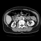 Hernie diaphragmatique TDM Abdomen Axial Temps veineux Hernie diaphragmatique TDM Abdomen Axial Temps veineux
