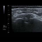 Tendinopathie biceps Echographie Membre supérieur Tendinopathie biceps Echographie Membre supérieur