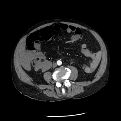 Hepatic fracture, Active hemorrhage Abdomen CT, Portal venous phase,  Arterial phase
