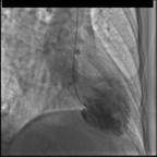 Syndrome de tako-tsubo - Sidération myocardique Ventriculographie Syndrome de tako-tsubo - Sidération myocardique Ventriculographie
