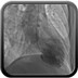 Syndrome de tako-tsubo - Sidération myocardique Ventriculographie