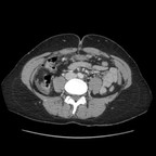 Ulcère duodénal perforé Axial Ulcère duodénal perforé Axial