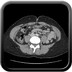 Ulcère duodénal perforé Axial