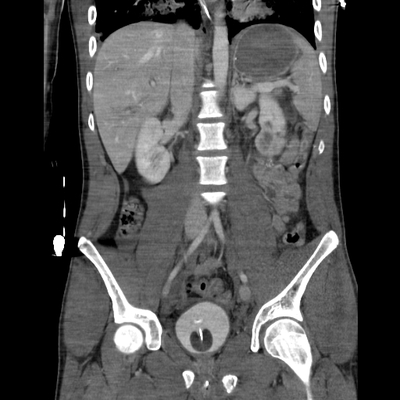 traumatisme cranien, fracture du massif facial, traumatisme thoracique, fracture pelvienne, traumatisme spléno-rénal abdomen portal coro 