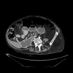 Bride digestive mimant un adénocarcinome du grêle TDM abdomen pelvis axial veineux Bride digestive mimant un adénocarcinome du grêle TDM abdomen pelvis axial veineux