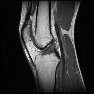 bipartite patella  MRI Lower limb Sagittal T1w