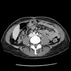 Tuberculose sacrée avec volumineux abcès Abdomen portal axial Tuberculose sacrée avec volumineux abcès Abdomen portal axial