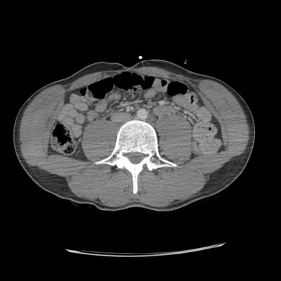 Thoracic Injuries, Subcapsular hemorrhage of liver, Pelvic injury Abdomen, Portal veinous phase
