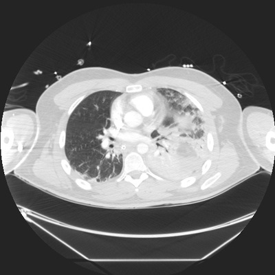 Traumatic diaphragmatic rupture, Thoracic and abdominal injuries, burst vertebral fracture, foot injuries Chest CT, Lung window, Axial plane