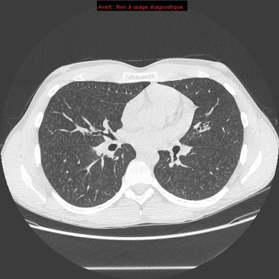 Déficit immunitaire commun variable : micronodules centrolobulaires sur bronchiolite  TDM Thorax Axial Fenêtre Air