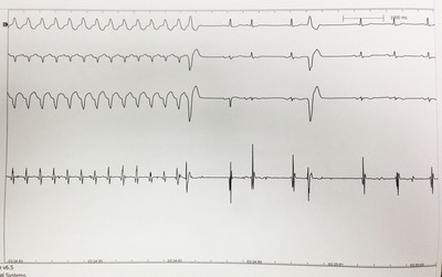Dysplasie arythmogène du ventriule droit (DAVD) : critère majeur en IRM ECG de réduction