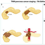 Pancreas cancer staging TNM-staging-pancreas-cancer Pancreas cancer staging TNM-staging-pancreas-cancer