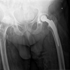 Fracture de l'extrémité supérieure du fémur peu déplacée sur descellement de l'implant fémoral d'une PTH Radiographie Fracture de l'extrémité supérieure du fémur peu déplacée sur descellement de l'implant fémoral d'une PTH Radiographie