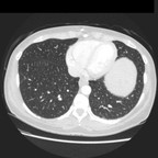 Sarcoidose pulmonaire et hépato splénique TDM Thorax Axial Fenêtre Air Sarcoidose pulmonaire et hépato splénique TDM Thorax Axial Fenêtre Air