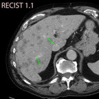 Response Evaluation Criteria in Solid Tumors RECIST-Response-Evaluation-Criteria-in-Solid-Tumors Response Evaluation Criteria in Solid Tumors RECIST-Response-Evaluation-Criteria-in-Solid-Tumors
