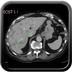 Response Evaluation Criteria in Solid Tumors RECIST-Response-Evaluation-Criteria-in-Solid-Tumors