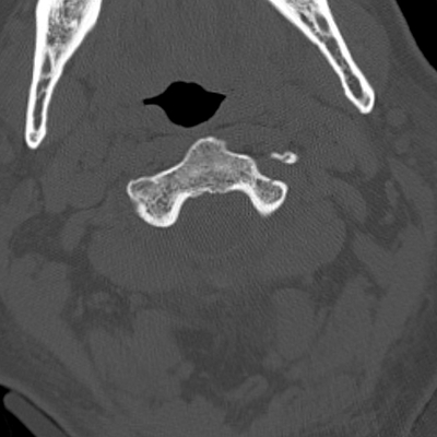 Subarachnoid Hemorrhage, Traumatic, Pneumothorax, Sternum fracture Cervical spine UPPER axial plane bone window