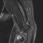 Desinsertion du tendon du biceps brachial IRM Membre supérieur Sagittal STIR Desinsertion du tendon du biceps brachial IRM Membre supérieur Sagittal STIR