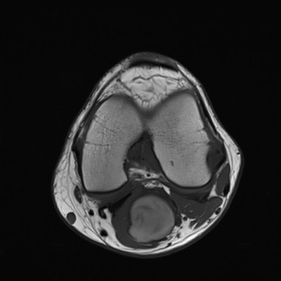 Anévrysme poplité thrombosé T1 axial