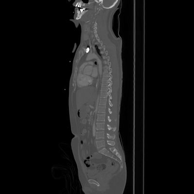 Occipital Condyle Fracture, Thoracic injuries, Hepatic trauma, Adrenal hemorrhage Chest, Abdomen and Pelvis, Sagittal plane, Bone window