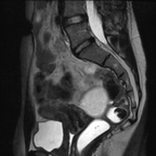 Tératome mature ovarien bilatéral Sagittal T2 Tératome mature ovarien bilatéral Sagittal T2