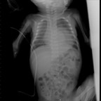 Neuroblastome thoracique à extension intra canalaire Rx Standard Neuroblastome thoracique à extension intra canalaire Rx Standard