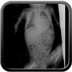 Neuroblastome thoracique à extension intra canalaire Rx Standard