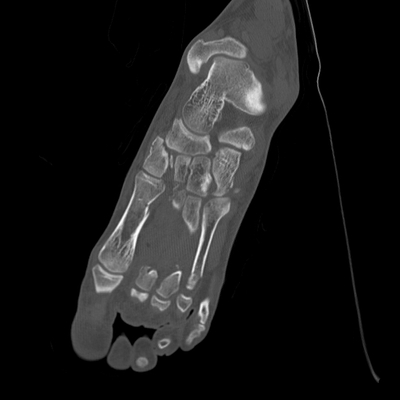 hernie diaphragmatique, traumatisme thoracique, traumatisme abdominal, burst fracture, fracture du pied pied gauche axial os