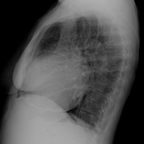 Péricardite chronique constrictive calcifiée Radio de thorax Péricardite chronique constrictive calcifiée Radio de thorax