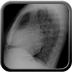 Péricardite chronique constrictive calcifiée Radio de thorax