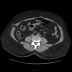 Sténose de l'anastomose bilio digestive. TDM Abdomen Pelvis Axial sans injection. Sténose de l'anastomose bilio digestive. TDM Abdomen Pelvis Axial sans injection.