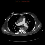 Faux anevrysme du TVBC droit après ablation de pacemaker TDM Thorax Axial Faux anevrysme du TVBC droit après ablation de pacemaker TDM Thorax Axial