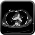 Faux anevrysme du TVBC droit après ablation de pacemaker  TDM Thorax Axial