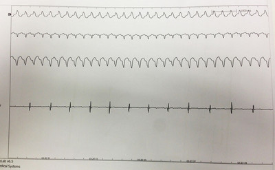 Dysplasie arythmogène du ventriule droit (DAVD) : critère majeur en IRM ECG