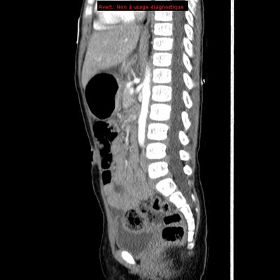Volvulus gastrique associé à une rate oscillante TDM abdomino-pelvienne (sagittal)