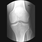 Ostéochondrite disséquante du condyle fémoral médial stade III Radiographie Genou Face Ostéochondrite disséquante du condyle fémoral médial stade III Radiographie Genou Face