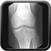Ostéochondrite disséquante du condyle fémoral médial stade III Radiographie Genou Face
