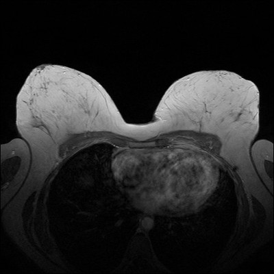 Récidive tardive de cancer du sein gauche Dynamique 2 min