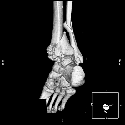 Occipital Condyle Fracture, Thoracic injuries, Hepatic trauma, Adrenal hemorrhage Right ankle, 3D VR 