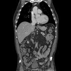 Ampullome TDM Abdomen Coronal Temps veineux Ampullome TDM Abdomen Coronal Temps veineux