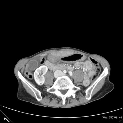 Rupture de l'aorte ascendante avec tamponnade sur hémopéricarde  TDM Abdomen Axial Temps veineux