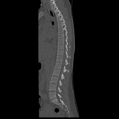 Abdominal vessels trauma, Intraperitoneal bladder rupture, Spleen infarction, Pelvic fracture Chest, Abdomen and Pelvis, Sagittal plane, Bone window