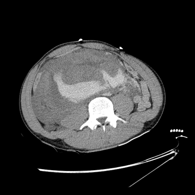 Renal vein rupture, Adrenal hemorrhage Abdomen CT, Delayed phase, Axial plane